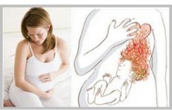 Изжога при беременности: что делать и как избавиться Какие продукты убирают изжогу при беременности
